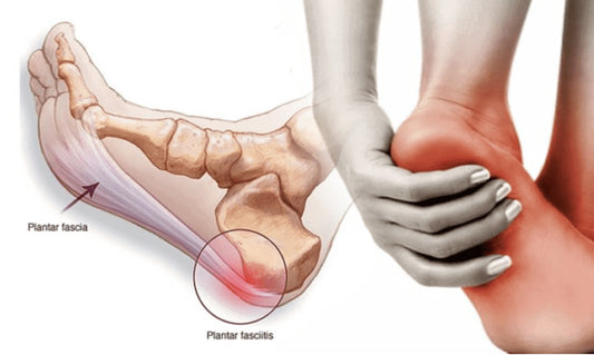 Understanding Plantar Fasciitis: Diagnosis and Treatment Innovations